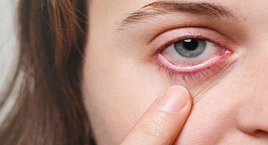 Göz Kuruluğuna Karşı Etkili Damla Tedavisi